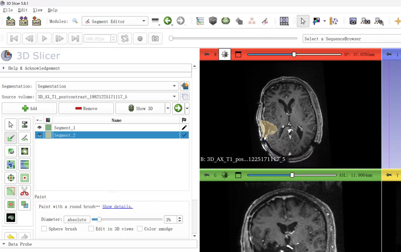 MRI tumour mask annotation in 3D Slicer