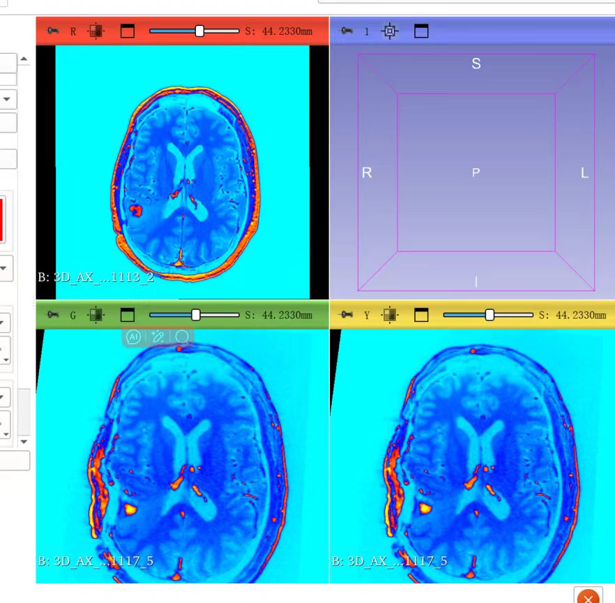 Colour-mapped MRI views in 3D Slicer